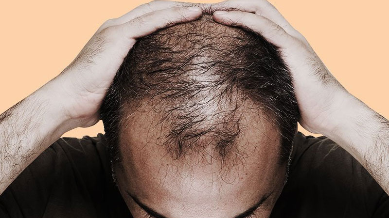 Reason why you are bald or have grey hairs Reason why you are bald or have grey hairs