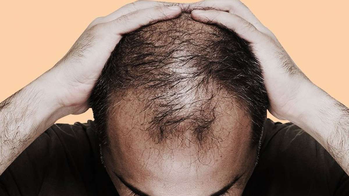 Reason why you are bald or have grey hairs Reason why you are bald or have grey hairs