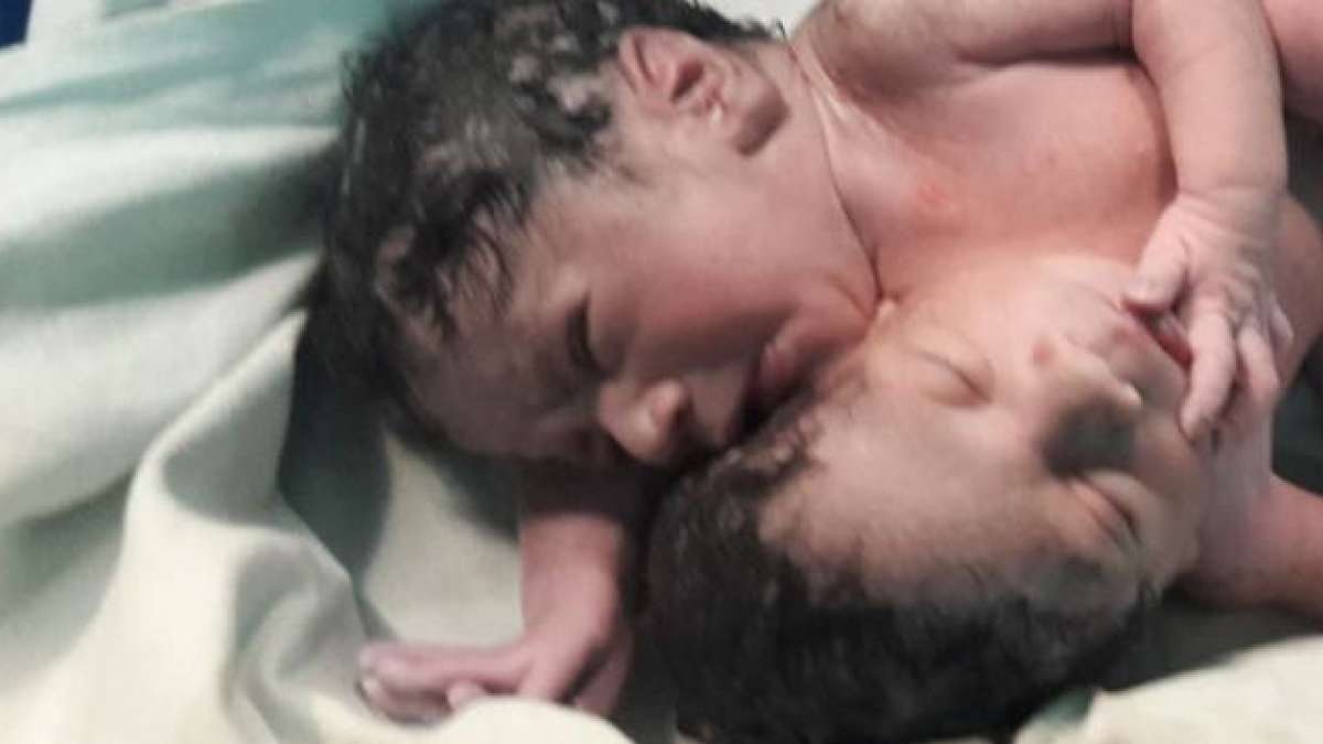 After Jaga-Kalia, another Odisha woman gives birth to conjoined twins with one heart, one liver After Jaga-Kalia, another Odisha woman gives birth to conjoined twins with one heart, one liver