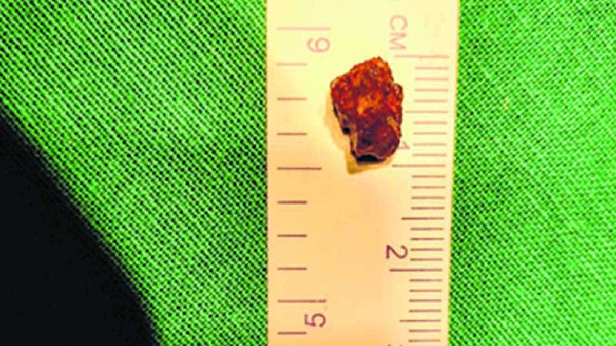 Three year old gulps supari, almost suffocates to death after a month Three year old gulps supari, almost suffocates to death after a month
