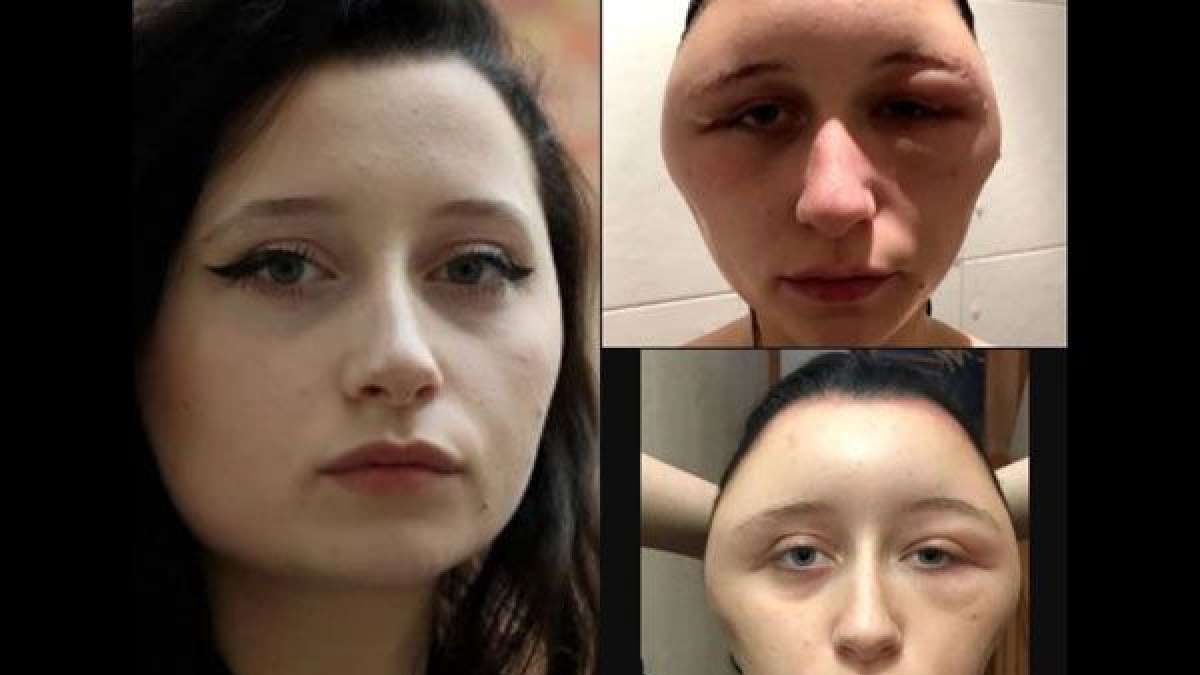 19-year-old woman face expanded and started to look like a light bulb after applying hair dye 19-year-old woman face expanded and started to look like a light bulb after applying hair dye