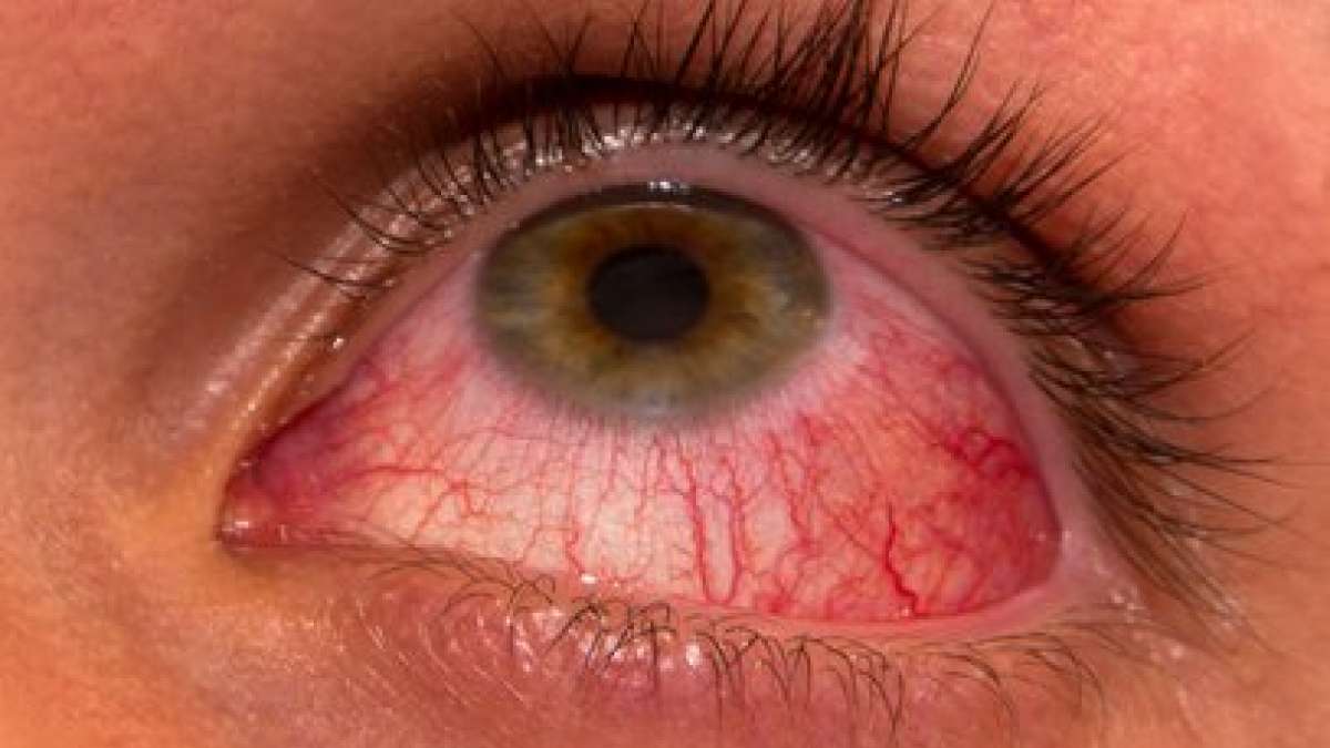 Scientists develop sight-saving treatment for eye infection Scientists develop sight-saving treatment for eye infection