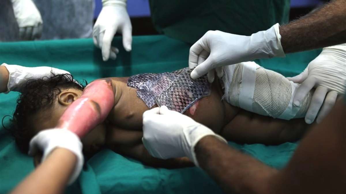 Fish skin cheaper, less painful in treating burns than bandages: Scientist Fish skin cheaper, less painful in treating burns than bandages: Scientist