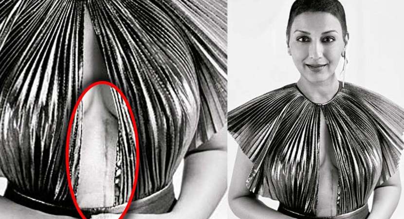 Sonali Bendre shares photo of her cancer surgery scar Sonali Bendre shares photo of her cancer surgery scar
