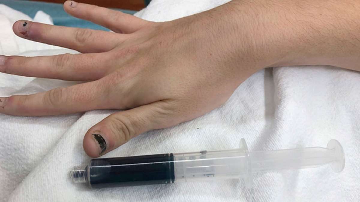 Methemoglobinemia: A rare disorder that turned a woman's blood blue Methemoglobinemia: A rare disorder that turned a woman's blood blue